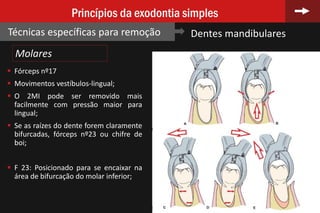 84
Princípios da exodontia simples
Técnicas específicas para remoção Dentes mandibulares
 Fórceps nº17
 Movimentos vestíbulos-lingual;
 O 2MI pode ser removido mais
facilmente com pressão maior para
lingual;
 Se as raízes do dente forem claramente
bifurcadas, fórceps nº23 ou chifre de
boi;
 F 23: Posicionado para se encaixar na
área de bifurcação do molar inferior;
Molares
 
