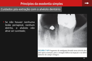 85
Princípios da exodontia simples
Cuidados pós-extração com o alvéolo dentário
 Se não houver nenhuma
lesão periapical, nenhum
detrito, o alvéolo não
deve ser curetado;
 