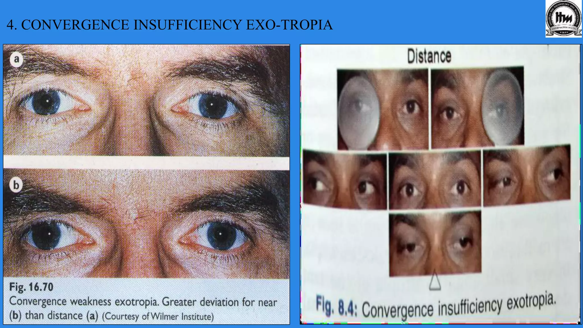 4. CONVERGENCE INSUFFICIENCY EXO-TROPIA
 