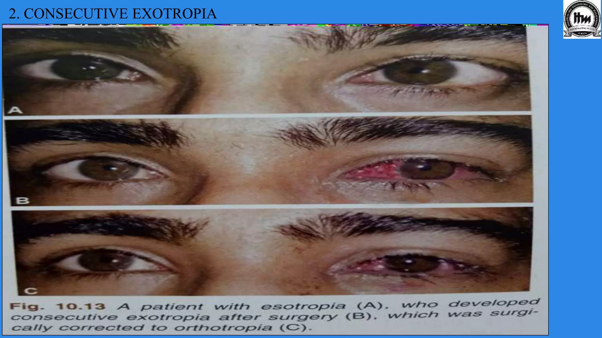 2. CONSECUTIVE EXOTROPIA
 