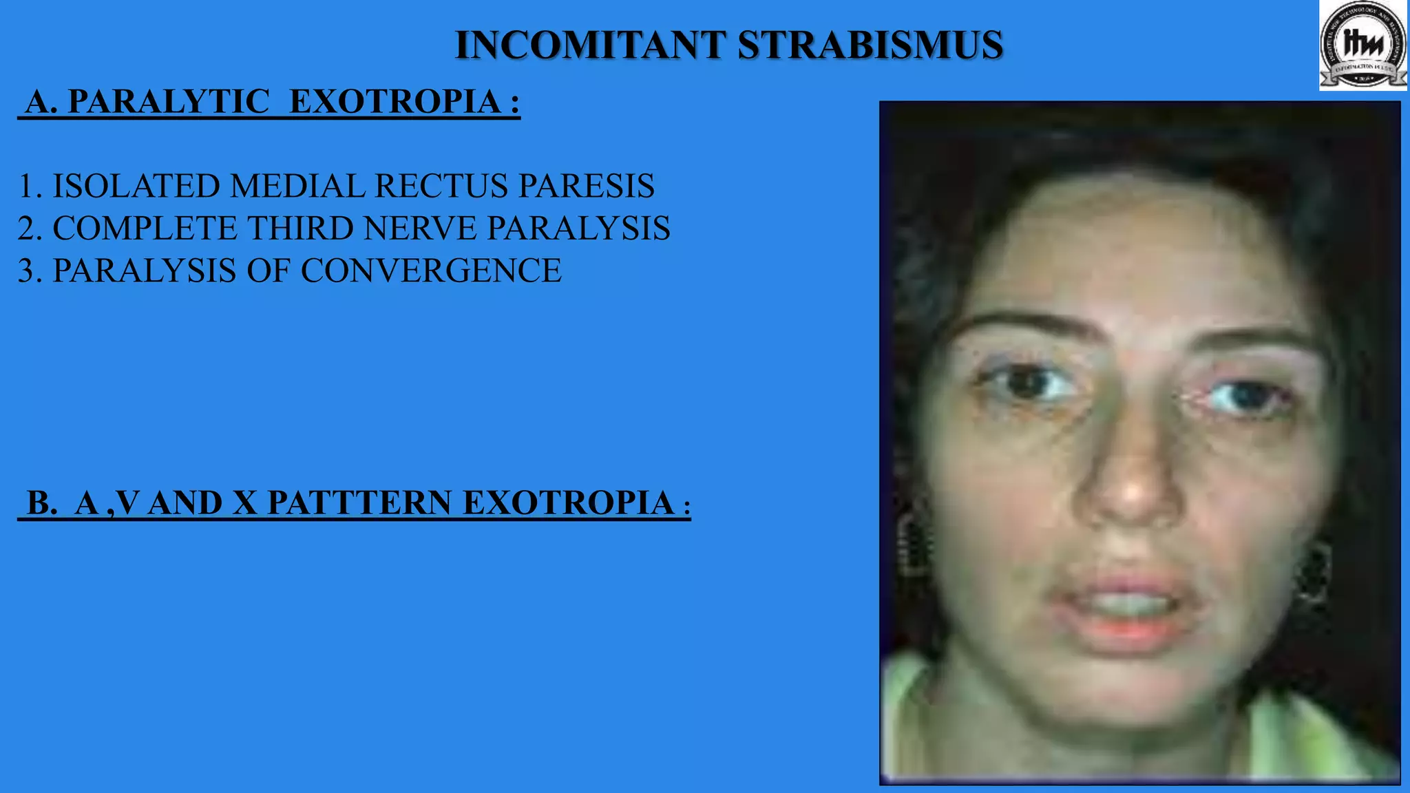 INCOMITANT STRABISMUS
A. PARALYTIC EXOTROPIA :
1. ISOLATED MEDIAL RECTUS PARESIS
2. COMPLETE THIRD NERVE PARALYSIS
3. PARALYSIS OF CONVERGENCE
B. A ,V AND X PATTTERN EXOTROPIA :
 