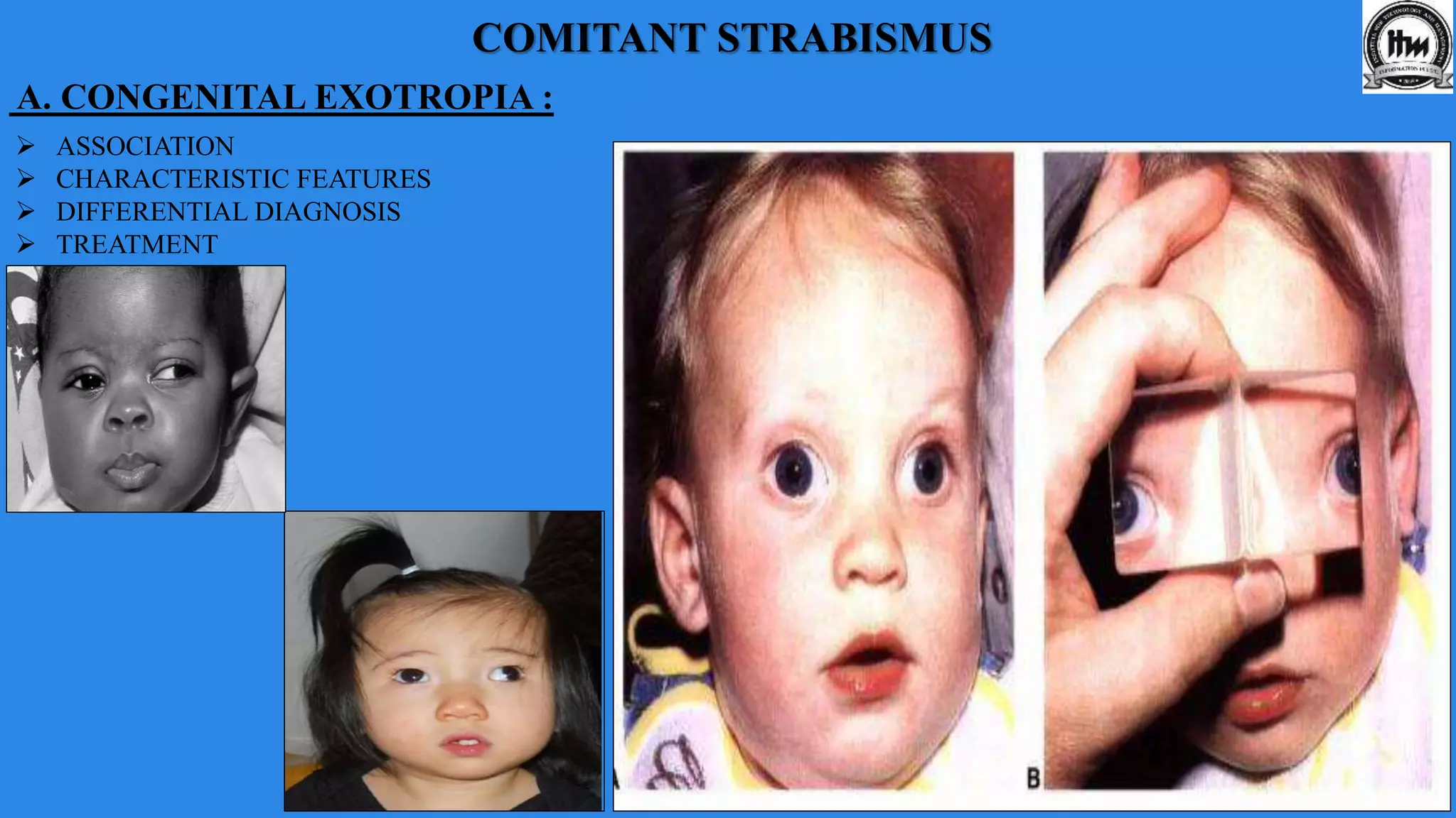 A. CONGENITAL EXOTROPIA :
 ASSOCIATION
 CHARACTERISTIC FEATURES
 DIFFERENTIAL DIAGNOSIS
 TREATMENT
COMITANT STRABISMUS
 