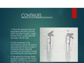 EXODONTIA -   PRINCIPLES AND TECHNIQUES.
