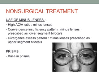 NONSURGICAL TREATMENT
USE OF MINUS LENSES :
• High AC/A ratio : minus lenses
• Convergence insufficiency pattern : minus lenses
prescribed as lower segment bifocals
• Divergence excess pattern : minus lenses prescribed as
upper segment bifocals
PRISMS :
• Base in prisms
 