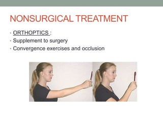 NONSURGICAL TREATMENT
• ORTHOPTICS :
• Supplement to surgery
• Convergence exercises and occlusion
 