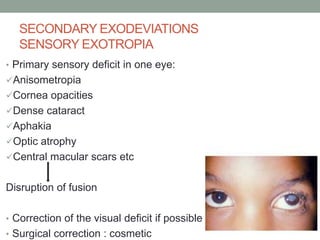SECONDARY EXODEVIATIONS
SENSORY EXOTROPIA
• Primary sensory deficit in one eye:
Anisometropia
Cornea opacities
Dense cataract
Aphakia
Optic atrophy
Central macular scars etc
Disruption of fusion
• Correction of the visual deficit if possible
• Surgical correction : cosmetic
 