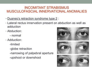  Duanes’s retraction syndrome type 2 :
• Lateral rectus innervation present on abduction as well as
adduction
• Abduction:
- normal
• Adduction:
-limited
-globe retraction
-narrowing of palpebral aperture
-upshoot or downshoot
INCOMITANT STRABISMUS
MUSCULOFASCIAL INNERVATIONAL ANOMALIES
 