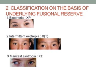 2. CLASSIFICATION ON THE BASIS OF
UNDERLYING FUSIONAL RESERVE
1.Exophoria : XP
2.Intermittent exotropia : X(T)
3.Manifest exotropia : XT
 
