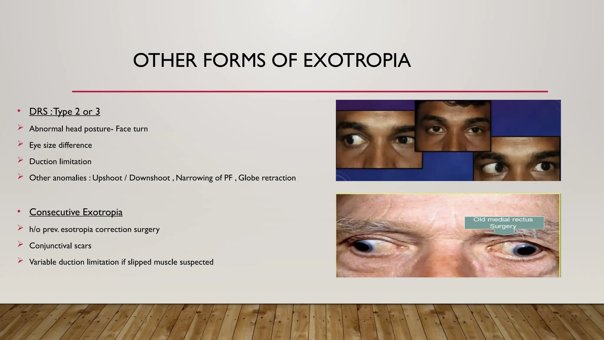 OTHER FORMS OF EXOTROPIA
• DRS :Type 2 or 3
 Abnormal head posture- Face turn
 Eye size difference
 Duction limitation
 Other anomalies : Upshoot / Downshoot , Narrowing of PF , Globe retraction
• Consecutive Exotropia
 h/o prev. esotropia correction surgery
 Conjunctival scars
 Variable duction limitation if slipped muscle suspected
 