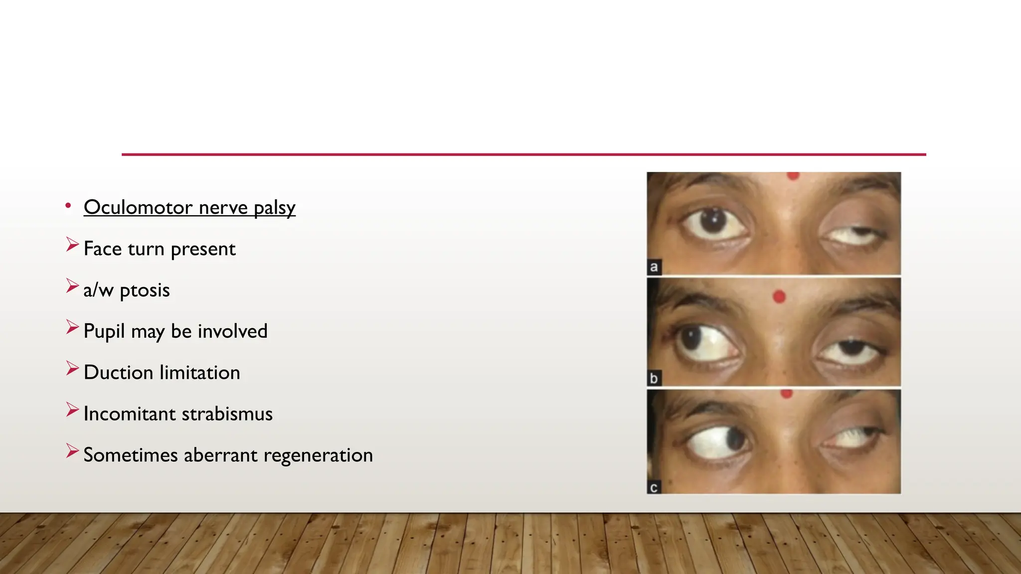 • Oculomotor nerve palsy
Face turn present
a/w ptosis
Pupil may be involved
Duction limitation
Incomitant strabismus
Sometimes aberrant regeneration
 