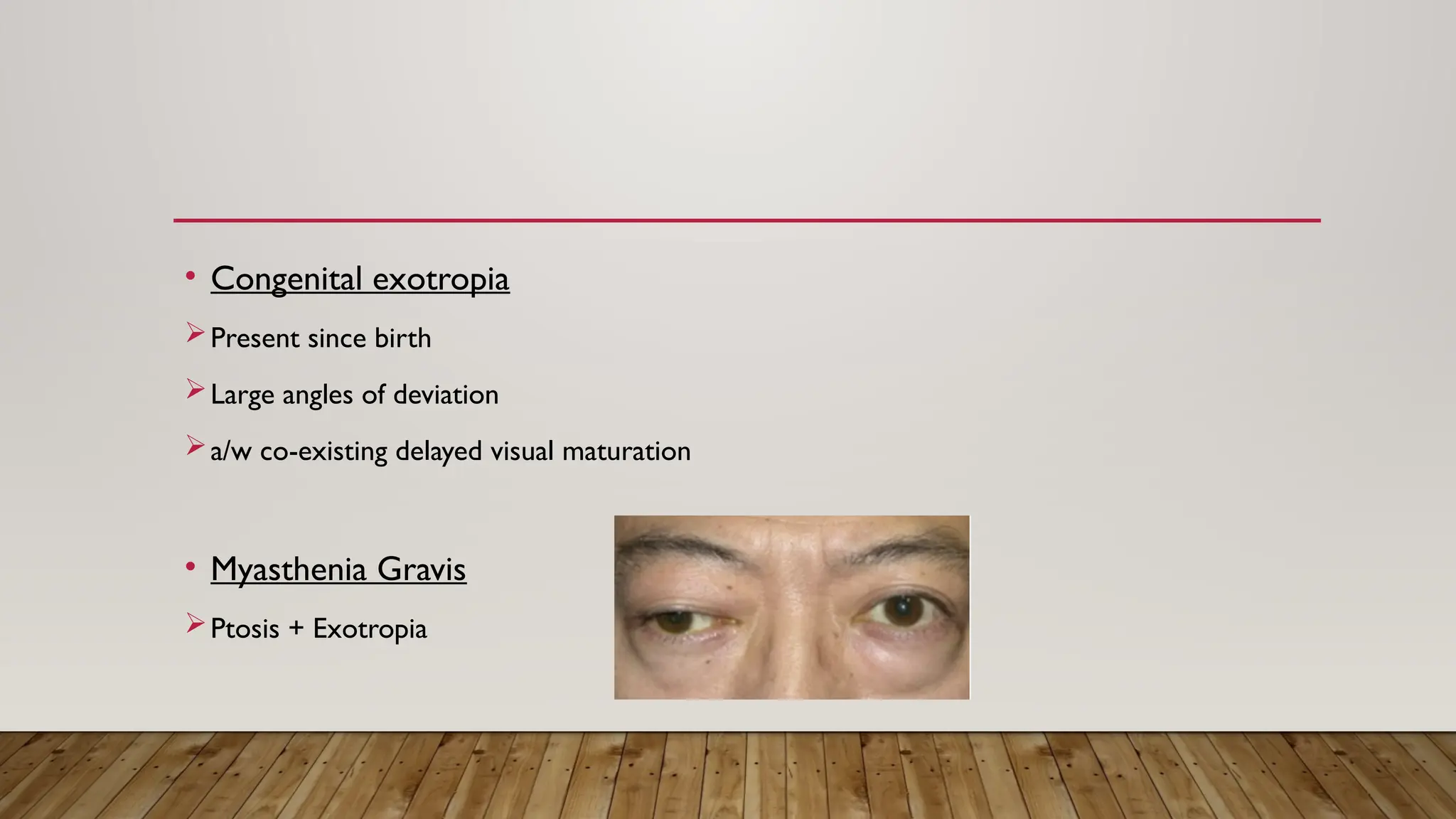 • Congenital exotropia
Present since birth
Large angles of deviation
a/w co-existing delayed visual maturation
• Myasthenia Gravis
Ptosis + Exotropia
 