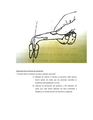 Aplicación de las fuerzas de extracción: 
“ El diente debe ser primero movido y después removido” 
A- Después de colocar el fórceps en posición, debe hacerse 
fuerza apical, de modo que las presiones ejercidas se 
transfieran adecuadamente a la raíz. 
B- Adecuar las posiciones del paciente y del operador, de 
modo que cada fuerza aplicada sea bien controlada y 
dirigida en el sentido preciso de dirección y magnitud. 
 