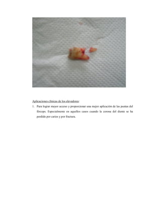 Aplicaciones clínicas de los elevadores: 
1. Para lograr mayor acceso y proporcionar una mejor aplicación de las puntas del 
fórceps. Especialmente en aquellos casos cuando la corona del diente se ha 
perdido por caries y por fractura. 
 