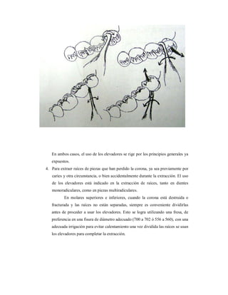 En ambos casos, el uso de los elevadores se rige por los principios generales ya 
expuestos. 
4. Para extraer raíces de piezas que han perdido la corona, ya sea previamente por 
caries y otra circunstancia, o bien accidentalmente durante la extracción. El uso 
de los elevadores está indicado en la extracción de raíces, tanto en dientes 
monoradiculares, como en piezas multiradiculares. 
En molares superiores e inferiores, cuando la corona está destruida o 
fracturada y las raíces no están separadas, siempre es conveniente dividirlas 
antes de proceder a usar los elevadores. Esto se logra utilizando una fresa, de 
preferencia en una fisura de diámetro adecuado (700 a 702 ó 556 a 560), con una 
adecuada irrigación para evitar calentamiento una vez dividida las raíces se usan 
los elevadores para completar la extracción. 
 