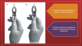 A. Forma correcta para sostener el
fórceps y realizar la prensión.
B. Forma correcta para sostener el
fórceps y realizar los movimientos
exodónticos.
 