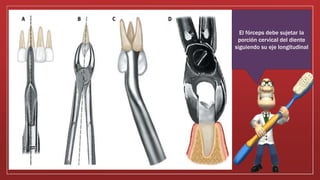 El fórceps debe sujetar la
porción cervical del diente
siguiendo su eje longitudinal
 