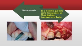 Sindesmotomía Es la maniobra que tiene
como fin desprender las
fibras gingivales
insertadas en el diente.
 