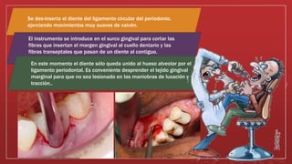 Se des-inserta el diente del ligamento circular del periodonto.
ejerciendo movimientos muy suaves de vaivén.
El instrumento se introduce en el surco gingival para cortar las
fibras que insertan el margen gingival al cuello dentario y las
fibras transeptales que pasan de un diente al contiguo.
En este momento el diente sólo queda unido al hueso alveolar por el
ligamento periodontal. Es conveniente desprender el tejido gingival
marginal para que no sea lesionado en las maniobras de luxación y
tracción..
 
