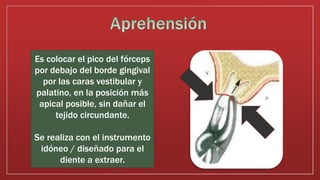 Es colocar el pico del fórceps
por debajo del borde gingival
por las caras vestibular y
palatino, en la posición más
apical posible, sin dañar el
tejido circundante.
Se realiza con el instrumento
idóneo / diseñado para el
diente a extraer.
 