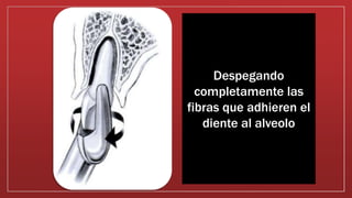 Despegando
completamente las
fibras que adhieren el
diente al alveolo
 