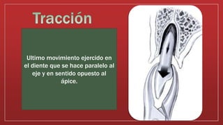 Ultimo movimiento ejercido en
el diente que se hace paralelo al
eje y en sentido opuesto al
ápice.
 