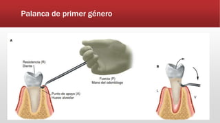 Palanca de primer género
 