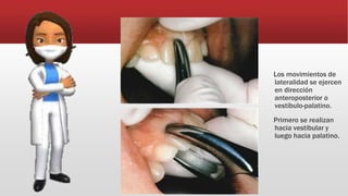 Los movimientos de
lateralidad se ejercen
en dirección
anteroposterior o
vestíbulo-palatino.
Primero se realizan
hacia vestibular y
luego hacia palatino.
 