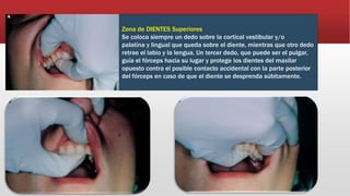 Zona de DIENTES Superiores
Se coloca siempre un dedo sobre la cortical vestibular y/o
palatina y lingual que queda sobre el diente, mientras que otro dedo
retrae el labio y la lengua. Un tercer dedo, que puede ser el pulgar,
guía el fórceps hacia su lugar y protege los dientes del maxilar
opuesto contra el posible contacto accidental con la parte posterior
del fórceps en caso de que el diente se desprenda súbitamente.
 