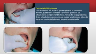 Zona de DIENTES Inferiores
En la mandíbula por la fuerza que se aplica en la extracción
dentaria, puede verse sometida a presiones que luxen las
articulaciones temporomandibulares. Para evitar estos problemas
de las articulaciones se recomienda colocar un abrebocas o taco de
goma que mantenga la boca en una apertura adecuada.
 