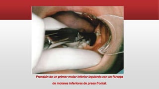 Prensión de un primer molar inferior izquierdo con un fórceps
de molares inferiores de presa frontal.
 