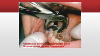 Prensión de un primer molar inferior derecho con un
fórceps de molares inferiores "cuerno de vaca".
 