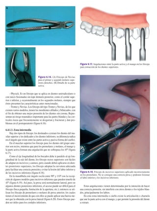 - Physick. Es un fórceps que se aplica en dientes unirradiculares o
con raíces fusionadas sin tope dentario posterior, como el cordal supe-
rior e inferior, y ocasionalmente en los segundos molares, siempre que
éstos presenten las características antes mencionadas.
- Trotter y Nevius. Los fórceps del tipo Trotter y Nevius, de los que
existen varios modelos, tienen los mordientes afilados y bifurcados, con
el fin de obtener una mejor prensión de los dientes sin corona. Repre-
sentan un riesgo traumático importante para las partes blandas y las cor-
ticales óseas que frecuentemente se desgarran y fracturan y dan pro-
blemas en el postoperatorio (figura 6.16).
6.4.1.3. Zona intermedia
Hay dos tipos de fórceps: los destinados a extraer los dientes del ma-
xilar superior y los dedicados a los dientes inferiores; su diferencia radica
en el ángulo que existe entre las partes activa y pasiva (forma del cuello).
En el maxilar superior los fórceps para los dientes del grupo ante-
rior son rectos, mientras que para los premolares y molares, el mango y
la parte activa forman una angulación que no sobrepasa los 45º (figura
6.17).
Como el eje longitudinal de los bocados debe ir paralelo al eje lon-
gitudinal de la raíz del diente, los fórceps rectos superiores son fáciles
de adaptar en incisivos y caninos, pero cuando deben aplicarse en dien-
tes posteriores superiores, los fórceps adoptan la curvatura adecuada
para facilitar una correcta prensión y evitar la lesión del labio inferior y
de los incisivos inferiores (figura 6.18).
En la mandíbula este ángulo oscila entre 90º y 110º con la excep-
ción de algunos modelos para incisivos inferiores que pueden tenerlo de
45º (figura 6.19). Así pues, la presa será normalmente lateral, pero en
algunos dientes posteriores inferiores, el acceso puede ser difícil para el
fórceps (boca pequeña, limitación de la apertura, etc.); entonces se uti-
lizan los fórceps de premolares o molares de presa anterior, los cuales
tienen el inconveniente de que con ellos se puede aplicar una fuerza me-
nor que la obtenida con la presa lateral (figura 6.20). Estos fórceps pue-
den ser útiles para los cordales inferiores.
Estas angulaciones vienen determinadas por la intención de hacer
una correcta prensión, sin interferir con otros dientes o los tejidos blan-
dos, principalmente los labios.
En esta zona intermedia o cuello existe la articulación o charnela
que une la parte activa con el mango, y que permite la prensión del diente
a extraer.
210 Principios básicos de la exodoncia
Figura 6.16. (A) Fórceps de Nevius
para el primer y segundo molares supe-
riores derechos. (B) Detalle de su parte
activa.
A
B
Figura 6.17. Angulaciones entre la parte activa y el mango en los fórceps
para extracción de los dientes superiores.
Figura 6.18. Fórceps de incisivos superiores aplicado incorrectamente
en los premolares. No se consigue una correcta presa y podemos lesionar
el labio inferior y los incisivos inferiores.
155-280 11/5/11 12:15 Página 210
 