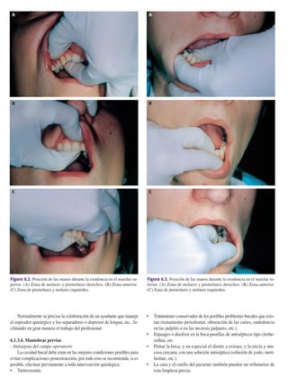 Normalmente se precisa la colaboración de un ayudante que maneja
el aspirador quirúrgico y los separadores o depresor de lengua, etc., fa-
cilitando en gran manera el trabajo del profesional.
6.1.3.4. Maniobras previas
- Antisepsia del campo operatorio
La cavidad bucal debe estar en las mejores condiciones posibles para
evitar complicaciones postextracción; por todo esto se recomienda, si es
posible, efectuar previamente a toda intervención quirúrgica:
• Tartrectomía.
• Tratamiento conservador de los posibles problemas bucales que exis-
tan (tratamiento periodontal, obturación de las caries, endodoncia
en las pulpitis o en las necrosis pulpares, etc.).
• Enjuages o disolver en la boca pastillas de antisépticos tipo clorhe-
xidina, etc.
• Pintar la boca, y en especial el diente a extraer, y la encía y mu-
cosa cercana, con una solución antiséptica (solución de yodo, mert-
hiolate, etc.).
• La cara y el cuello del paciente también pueden ser tributarios de
esta limpieza previa.
202 Principios básicos de la exodoncia
Figura 6.2. Posición de las manos durante la exodoncia en el maxilar su-
perior. (A) Zona de molares y premolares derechos. (B) Zona anterior.
(C) Zona de premolares y molares izquierdos.
A
B
C
Figura 6.3. Posición de las manos durante la exodoncia en el maxilar in-
ferior. (A) Zona de molares y premolares derechos. (B) Zona anterior.
(C) Zona de premolares y molares izquierdos.
A
B
C
155-280 11/5/11 12:15 Página 202
 