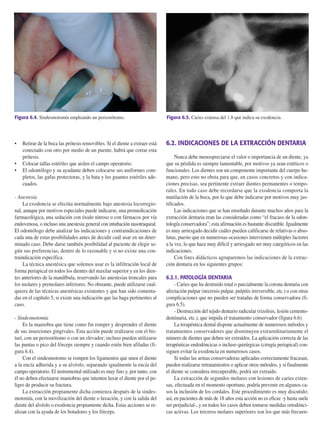 • Retirar de la boca las prótesis removibles. Si el diente a extraer está
conectado con otro por medio de un puente, habrá que cortar esta
prótesis.
• Colocar tallas estériles que aislen el campo operatorio.
• El odontólogo y su ayudante deben colocarse sus uniformes com-
pletos, las gafas protectoras, y la bata y los guantes estériles ade-
cuados.
- Anestesia
La exodoncia se efectúa normalmente bajo anestesia locorregio-
nal, aunque por motivos especiales puede indicarse, una premedicación
farmacológica, una sedación con óxido nitroso o con fármacos por vía
endovenosa, o incluso una anestesia general con intubación nasotraqueal.
El odontólogo debe analizar las indicaciones y contraindicaciones de
cada una de estas posibilidades antes de decidir cuál usar en un deter-
minado caso. Debe darse también posibilidad al paciente de elegir se-
gún sus preferencias, dentro de lo razonable y si no existe una con-
traindicación específica.
La técnica anestésica que solemos usar es la infiltración local de
forma periapical en todos los dientes del maxilar superior y en los dien-
tes anteriores de la mandíbula, reservando las anestesias troncales para
los molares y premolares inferiores. No obstante, puede utilizarse cual-
quiera de las técnicas anestésicas existentes y que han sido comenta-
das en el capítulo 5, si existe una indicación que las haga pertinentes al
caso.
- Sindesmotomía
Es la maniobra que tiene como fin romper y desprender el diente
de sus inserciones gingivales. Esta acción puede realizarse con el bis-
turí, con un periostótomo o con un elevador; incluso pueden utilizarse
las puntas o pico del fórceps siempre y cuando estén bien afiladas (fi-
gura 6.4).
Con el sindesmotomo se rompen los ligamentos que unen el diente
a la encía adherida y a su alvéolo, separando igualmente la encía del
campo operatorio. El instrumental utilizado es muy fino y, por tanto, con
él no deben efectuarse maniobras que intenten luxar el diente por el pe-
ligro de producir su fractura.
La extracción propiamente dicha comienza después de la sindes-
motomía, con la movilización del diente o luxación, y con la salida del
diente del alvéolo o exodoncia propiamente dicha. Estas acciones se re-
alizan con la ayuda de los botadores y los fórceps.
6.2. INDICACIONES DE LA EXTRACCIÓN DENTARIA
Nunca debe menospreciarse el valor o importancia de un diente, ya
que su pérdida es siempre lamentable, por motivos ya sean estéticos o
funcionales. Los dientes son un componente importante del cuerpo hu-
mano, pero esto no obsta para que, en casos concretos y con indica-
ciones precisas, sea pertinente extraer dientes permanentes o tempo-
rales. En todo caso debe recordarse que la exodoncia comporta la
mutilación de la boca, por lo que debe indicarse por motivos muy jus-
tificados.
Las indicaciones que se han enseñado durante muchos años para la
extracción dentaria eran las consideradas como “el fracaso de la odon-
tología conservadora”; esta afirmación es bastante discutible. Igualmente
es muy arriesgado decidir cuáles pueden calificarse de relativas o abso-
lutas, puesto que en numerosas ocasiones intervienen múltiples factores
a la vez, lo que hace muy difícil y arriesgado ser muy categóricos en las
indicaciones.
Con fines didácticos agruparemos las indicaciones de la extrac-
ción dentaria en los siguientes grupos:
6.2.1. PATOLOGÍA DENTARIA
- Caries que ha destruido total o parcialmente la corona dentaria con
afectación pulpar (necrosis pulpar, pulpitis irreversible, etc.) o con otras
complicaciones que no pueden ser tratadas de forma conservadora (fi-
gura 6.5).
- Destrucción del tejido dentario radicular (rizolisis, lesión cemento-
dentinaria, etc.), que impida el tratamiento conservador (figura 6.6).
La terapéutica dental dispone actualmente de numerosos métodos y
tratamientos conservadores que disminuyen extraordinariamente el
número de dientes que deben ser extraídos. La aplicación correcta de las
terapéuticas endodóncicas o incluso quirúrgicas (cirugía periapical) con-
siguen evitar la exodoncia en numerosos casos.
Si todas las armas conservadoras aplicadas correctamente fracasan,
pueden realizarse retratamientos o aplicar otros métodos, y si finalmente
el diente se considera irrecuperable, podrá ser extraído.
La extracción de segundos molares con lesiones de caries exten-
sas, efectuada en el momento oportuno, podría prevenir en algunos ca-
sos la inclusión de los cordales. Este procedimiento es muy discutido;
así, en pacientes de más de 18 años esta acción no es eficaz -y hasta suele
ser perjudicial-, y en todos los casos deben tomarse medidas ortodónci-
cas activas. Los terceros molares superiores son los que más frecuen-
Cosme Gay Escoda, Leonardo Berini Aytés 203
Figura 6.4. Sindesmotomía empleando un periostótomo. Figura 6.5. Caries extensa del 1.8 que indica su exodoncia.
155-280 11/5/11 12:15 Página 203
 