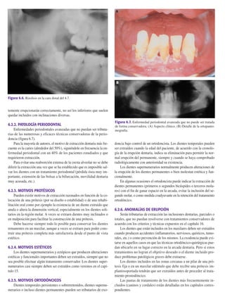 temente erupcionarán correctamente, no así los inferiores que suelen
quedar incluidos con inclinaciones diversas.
6.2.2. PATOLOGÍA PERIODONTAL
Enfermedades periodontales avanzadas que no puedan ser tributa-
rias de las numerosas y eficaces técnicas conservadoras de la perio-
doncia (figura 6.7).
Para la mayoría de autores, el motivo de extracción dentaria más fre-
cuente es la caries (alrededor del 50%), siguiéndole en frecuencia la en-
fermedad periodontal con un 40% de los pacientes estudiados y que
requirieron extracción.
Para evitar una reabsorción extensa de la cresta alveolar no se debe
diferir la extracción una vez que se ha establecido que es imposible sal-
var los dientes con un tratamiento periodontal (pérdida ósea muy im-
portante, extensión de las bolsas a la bifurcación, movilidad dentaria
muy acusada, etc.).
6.2.3. MOTIVOS PROTÉSICOS
Pueden existir motivos de extracción razonados en función de la co-
locación de una prótesis (por su diseño o estabilidad) o de una rehabi-
litación oral como por ejemplo la existencia de un diente extruido que
anula o altera la dimensión vertical, especialmente en los dientes soli-
tarios en la región molar. A veces se extraen dientes muy inclinados o
en malposición para facilitar la construcción de una prótesis.
Debe hacerse siempre todo lo posible para conservar los dientes
remanentes en un maxilar, aunque a veces se extraen para poder cons-
truir una prótesis completa más satisfactoria desde el punto de vista
estético.
6.2.4. MOTIVOS ESTÉTICOS
Los dientes supernumerarios y ectópicos que producen alteraciones
estéticas y funcionales importantes deben ser extraídos, siempre que no
sea posible efectuar algún tratamiento conservador. Los dientes super-
numerarios casi siempre deben ser extraídos como veremos en el capí-
tulo 15.
6.2.5. MOTIVOS ORTODÓNCICOS
Dientes temporales persistentes o sobrerretenidos, dientes supernu-
merarios o incluso dientes permanentes pueden ser tributarios de exo-
doncia bajo control de un ortodoncista. Los dientes temporales pueden
ser extraídos cuando la edad del paciente, de acuerdo con la cronolo-
gía de la erupción dentaria, indica su eliminación para permitir la nor-
mal erupción del permanente, siempre y cuando se haya comprobado
radiológicamente con anterioridad su existencia.
Los dientes supernumerarios normalmente producen alteraciones de
la erupción de los dientes permanentes o bien molestan estética y fun-
cionalmente.
En algunas ocasiones el ortodoncista puede indicar la extracción de
dientes permanentes (primeros o segundos bicúspides o terceros mola-
res) con el fin de ganar espacio en la arcada, evitar la inclusión del se-
gundo molar, o como medida coadyuvante en la retención del tratamiento
ortodóncico.
6.2.6. ANOMALÍAS DE ERUPCIÓN
Serán tributarias de extracción las inclusiones dentarias, parciales o
totales, que no puedan resolverse con tratamientos conservadores de
acuerdo con los criterios y técnicas expuestos en el capítulo 16.
Los dientes que están incluidos en los maxilares deben ser extraídos
cuando producen accidentes (inflamatorios, nerviosos, quísticos, tumo-
rales, etc.) o como prevención de los mismos. La exodoncia puede evi-
tarse en aquellos casos en que las técnicas ortodóncico-quirúrgicas pue-
dan ubicarlo en su lugar correcto en la arcada dentaria. Pero si estos
tratamientos no logran el objetivo deseado o el diente incluido pro-
duce problemas patológicos graves debe extraerse.
Los dientes incluidos en las zonas cercanas a un pilar de una pró-
tesis fija o en un maxilar edéntulo que debe recibir una prótesis im-
plantosoportada tendrán que ser extraídos antes de proceder al trata-
miento prostodóncico.
Las pautas de tratamiento de los dientes más frecuentemente in-
cluidos (caninos y cordales) están detalladas en los capítulos corres-
pondientes.
204 Principios básicos de la exodoncia
Figura 6.6. Rizolisis en la cara distal del 4.7.
Figura 6.7. Enfermedad periodontal avanzada que no puede ser tratada
de forma conservadora. (A) Aspecto clínico. (B) Detalle de la ortopanto-
mografía.
A
B
155-280 11/5/11 12:15 Página 204
 