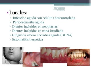 •Locales:
▫ Infección aguda con celulitis descontrolada
▫ Pericoronaritis aguda
▫ Dientes incluidos en neoplasias
▫ Dientes incluidos en zona irradiada
▫ Gingivitis ulcero necrótica aguda (GUNA)
▫ Estomatitis herpética
http://www.radiodent.cl
/cirugia_oral/indicacion
es_y_contraindicaciones
_de_exodoncia.pdf
 