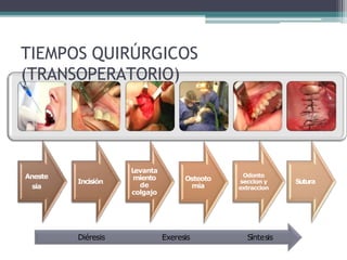 Aneste
sia
Incisión
L
evanta
miento
de
colgajo
Osteoto
mia
Odonto
seccion y
extraccion
Sutura
TIEMPOS QUIRÚRGICOS
(TRANSOPERATORIO)
Síntesis
Exeresis
Diéresis
 