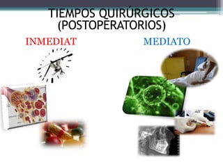 TIEMPOS QUIRÚRGICOS
(POSTOPERATORIOS)
INMEDIAT MEDIATO
O
 