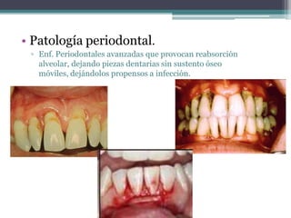 • Patología periodontal.
▫ Enf. Periodontales avanzadas que provocan reabsorción
alveolar, dejando piezas dentarias sin sustento óseo
móviles, dejándolos propensos a infección.
 
