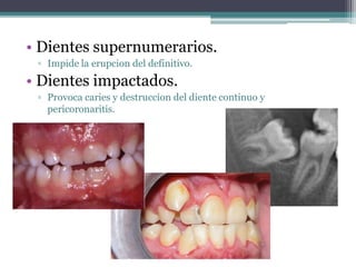 • Dientes supernumerarios.
▫ Impide la erupcion del definitivo.
• Dientes impactados.
▫ Provoca caries y destruccion del diente continuo y
pericoronaritis.
 