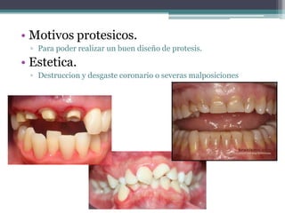 • Motivos protesicos.
▫ Para poder realizar un buen diseño de protesis.
• Estetica.
▫ Destruccion y desgaste coronario o severas malposiciones
 