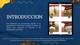 Exodoncia Con Preservaci n Alveolar 3 pdf exodoncia-con-preservaci-n-alveolar-3-pdf