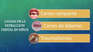 CAUSAS DE LA
EXTRACCIÓN
DENTAL EN NIÑOS
Caries rampante
Caries de biberón
Traumatismos
 
