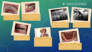  INDICACIONES
1.Dientes intruidos por
trauma
1.Si se ha producido infección en el
área periapical o interradicular y
no se puede eliminar por otros
medios.
1.En dientes que estén
destruidos en tal grado que
sea imposible restaurarlos.
1.Si los dientes temporales
están interfiriendo la erupción
normal de los permanentes .
Dientes de leche en relación o
adyacentes con un proceso
quístico o tumoral benigno.
Erupción ectópica de caninos
maxilares, o cuando existe el riesgo de
resorción de los incisivos permanentes
1.Presencia de enfermedades
sistémicas que contraindiquen la
conservación del órgano dental
afectado, como ocurre en el caso
de la enfermedad de Still
 