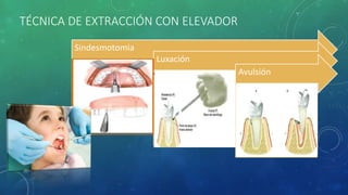 TÉCNICA DE EXTRACCIÓN CON ELEVADOR
Sindesmotomia
Luxación
Avulsión
 