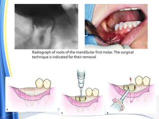 Radiograph of roots of the mandibular first molar.The surgical
technique is indicated for their removal
 