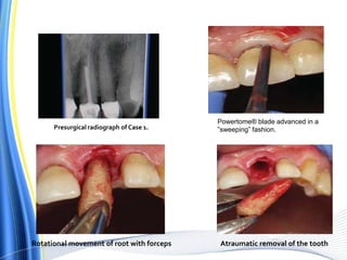 Presurgical radiograph of Case 1.
Powertome® blade advanced in a
”sweeping” fashion.
Rotational movement of root with forceps Atraumatic removal of the tooth
 