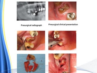 Presurgical radiograph Presurgical clinical presentation
 
