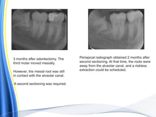3 months after odontectomy. The
third molar moved mesially.
However, the mesial root was still
in contact with the alveolar canal.
A second sectioning was required.
Periapical radiograph obtained 2 months after
second sectioning. At that time, the roots were
away from the alveolar canal, and a riskless
extraction could be scheduled.
 