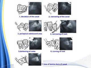 1, deviation of the canal 2, narrowing of the canal
3, periapical radiolucent area 4, narrowing of root;
5,darkening of roots 6, curving of root
7, loss of lamina dura of canal
 